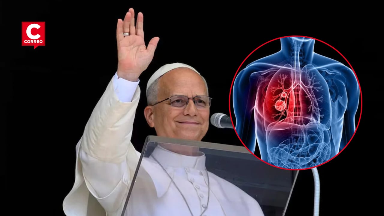 ¿Qué significa tener un nódulo pulmonar? Esto explica un oncólogo tras el caso del papa León XIV