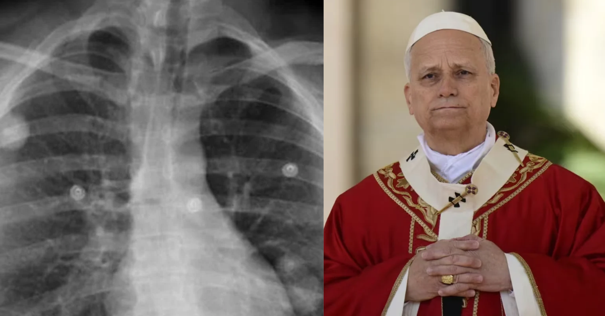 Papa León XIV será hospitalizado este martes 13 para ser operado por nódulo en el pulmón